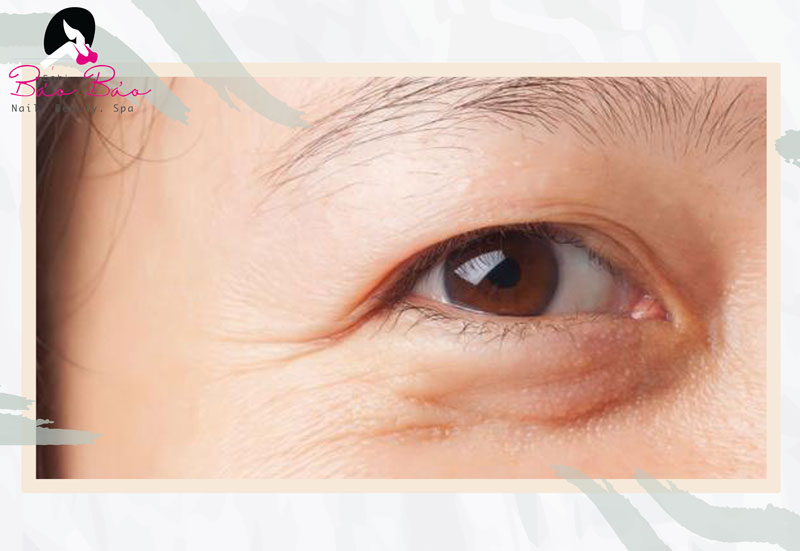Nguyên nhân gây ra lão hóa tại vùng mắt